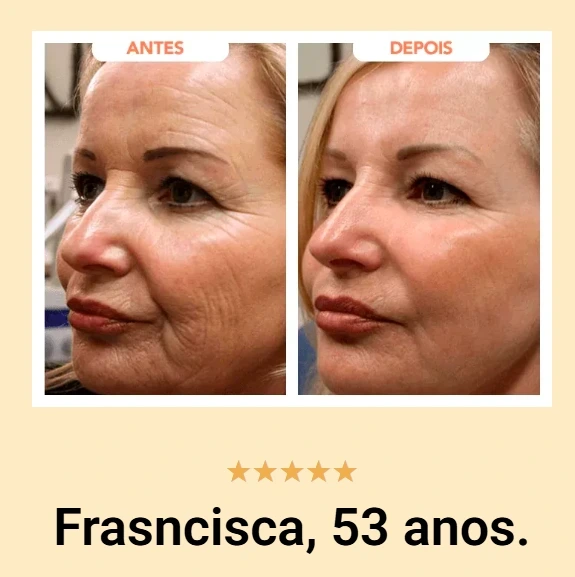 Resultados Trans Resveratrol Gota 30 dias antes e depois